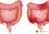 Какви са симптомите на раздразненото дебело черво