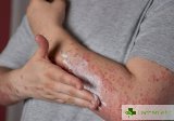 Коксаки вирусът: Същност, симптоми, лечение