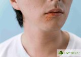Лечение на херпес - ефикасни мазила и методи