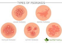 Гъбички по кожата и техните видове