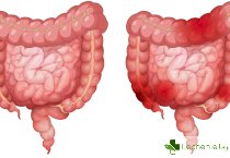 Синдром на раздразненото дебело черво