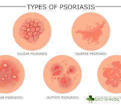 Гъбички по кожата и техните видове