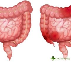 Синдром на раздразненото дебело черво