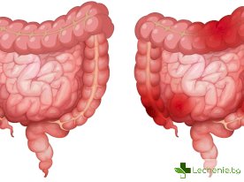 Синдром на раздразненото дебело черво