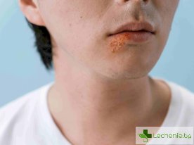 Лечение на херпес