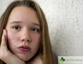 Акнето през пубертета не е болест, а съвсем нормално състояние на кожата