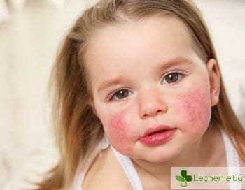Алергии по наследство – по какво и как се разпознават