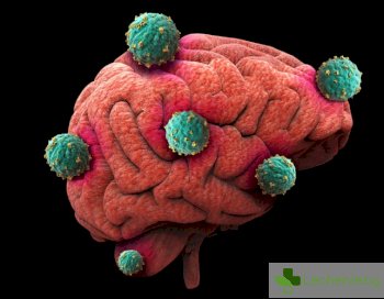 Антихистамините потенциално лекарство при рак на мозъка