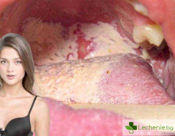 Кои са симптомите на гонорея на устата