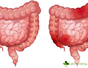 Синдром на раздразненото дебело черво
