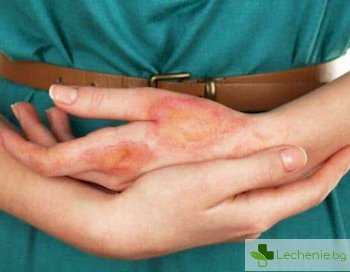 Анетодермия - какво се случва с кожата