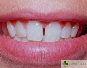 Диастема - разстояние между предните зъби