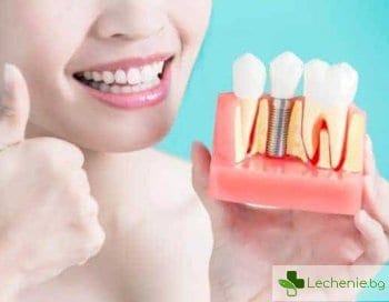Грижа за зъбите след поставяне на импланти - основни правила