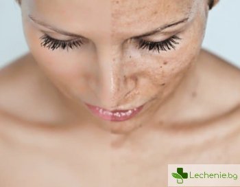 Как да изравним тена на кожата - топ 5 най-ефективни разкрасителни процедури