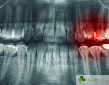 Зъбна киста - мълчаливата опасност
