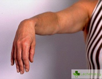 Невропатия на лъчевия нерв - когато си легнем върху ръката, симптоми и лечение