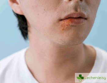 Лечение на херпес