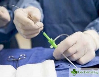 Операции през миниатюрни разрези - чудесата на лапароскопската хирургия