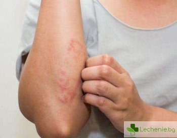 Парапсориазис - какво се случва с кожата