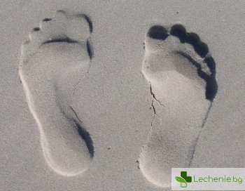 Плоскостъпие при възрастни - причини и лечение