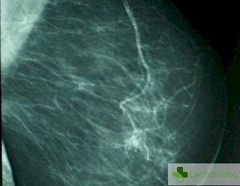 Защо учените оспорват мамографията?