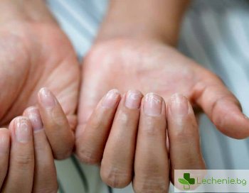 Чупливи нокти - могат ли да са симптом на болест