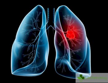 Кои са симптомите за рак на белия дроб