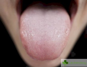 Как хроничното травмиране на езика може да доведе до рак