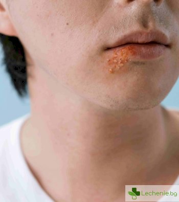 Лечение на херпес