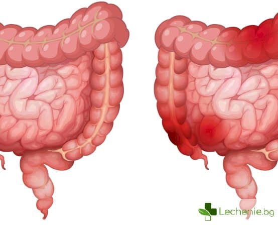 Синдром на раздразненото дебело черво
