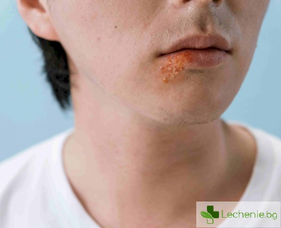 Лечение на херпес