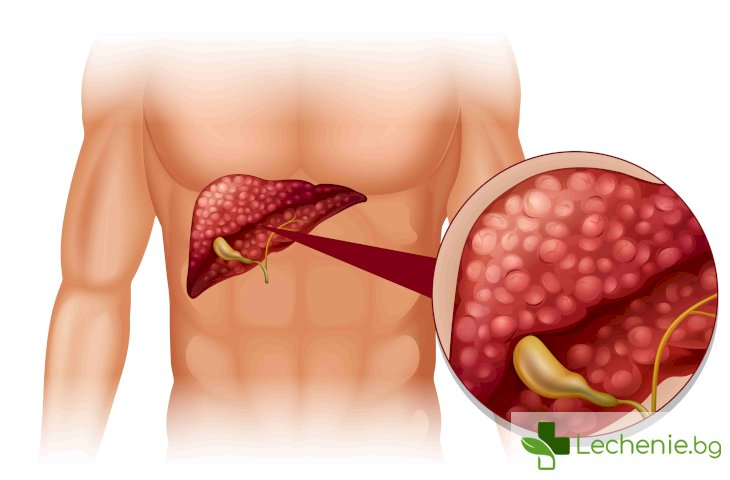 Чернодробен хемангиом