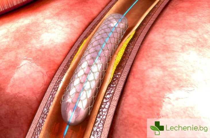 Изследване на коронарни артерии