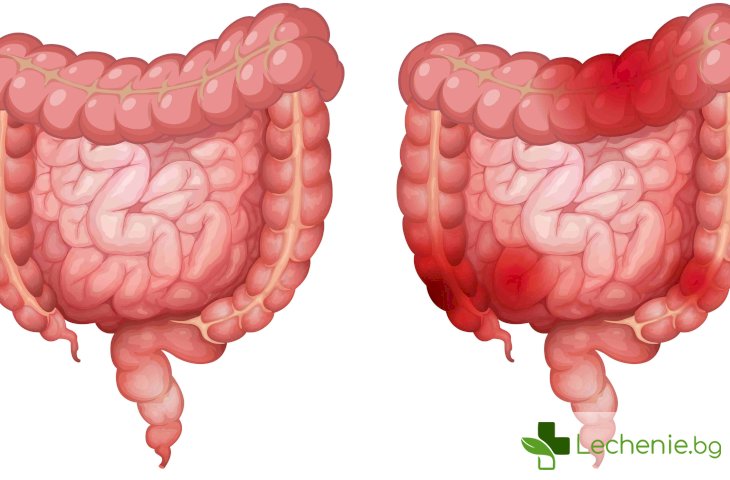 Синдром на раздразненото дебело черво