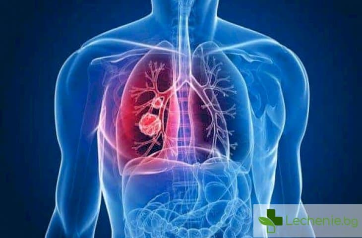 Бактериална деструкция на белите дробове - причини и лечение
