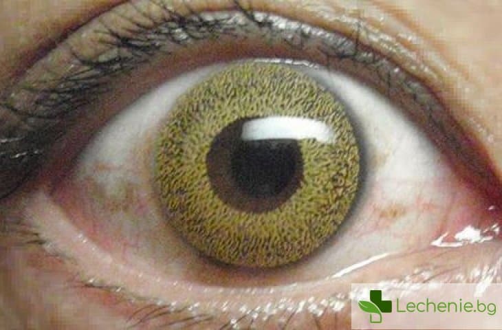 Диабетна ретинопатия