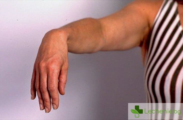 Невропатия на лъчевия нерв - когато си легнем върху ръката, симптоми и лечение