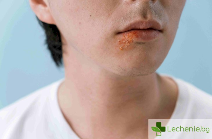 Лечение на херпес