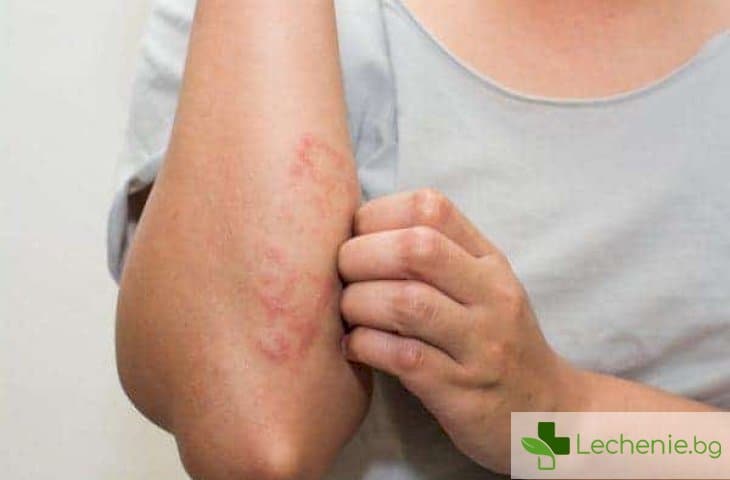 Парапсориазис - какво се случва с кожата