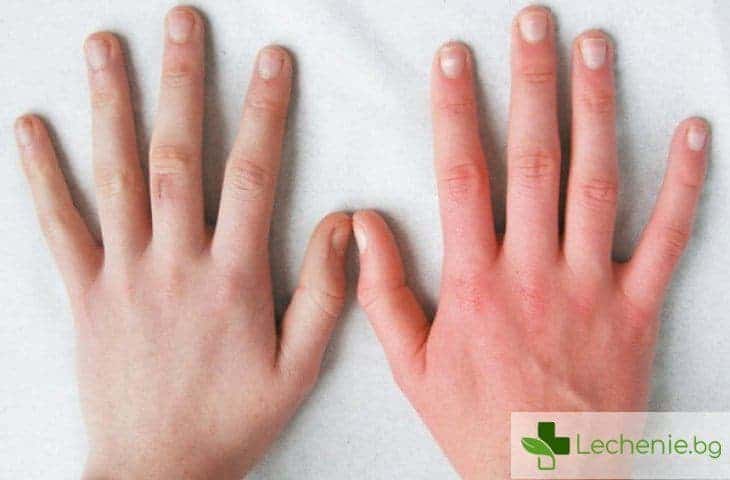 Как да се избавите от честото зачервяване на кожата на ръцете
