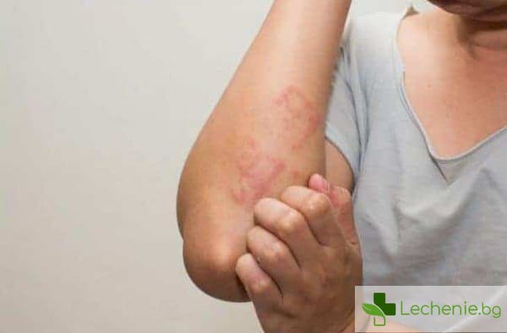 Токсико-алергичен дерматит или токсидермия - симптоми и лечение