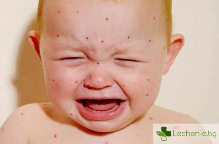 Сериозни усложнения след "безобидна" варицела при деца
