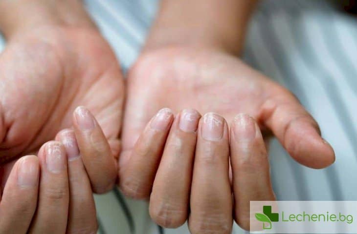 Чупливи нокти - могат ли да са симптом на болест