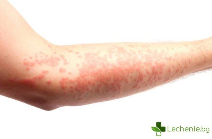 Неврофиброматоза – причини за болестта и увреждане на кожата