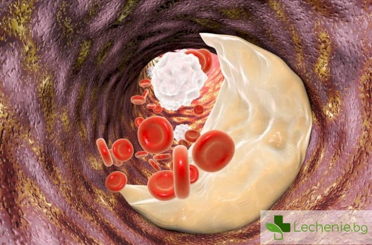 Лимфната система може да се пребори с плаката в кръвоносните съдове