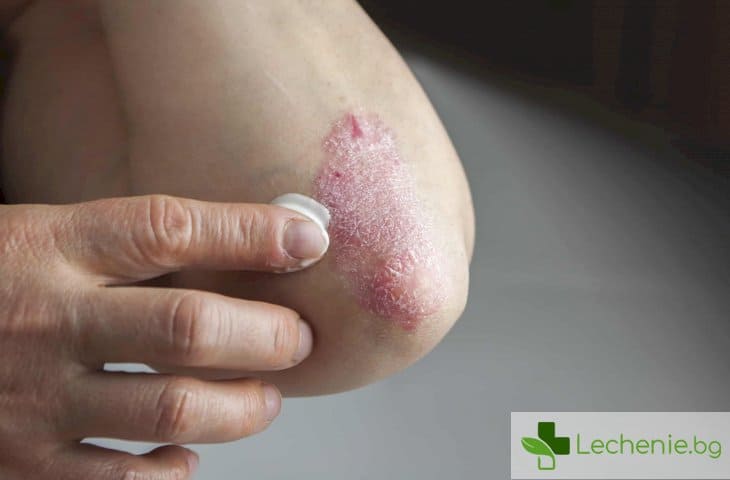 Псориазис може да разболее от няколко вида рак, включително и на кожата