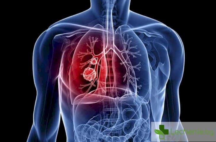 4 ранни признака за рак на белия дроб