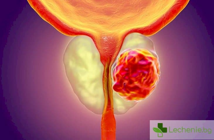 Лечение на рак на простатата може да ни докара до старческо слабоумие