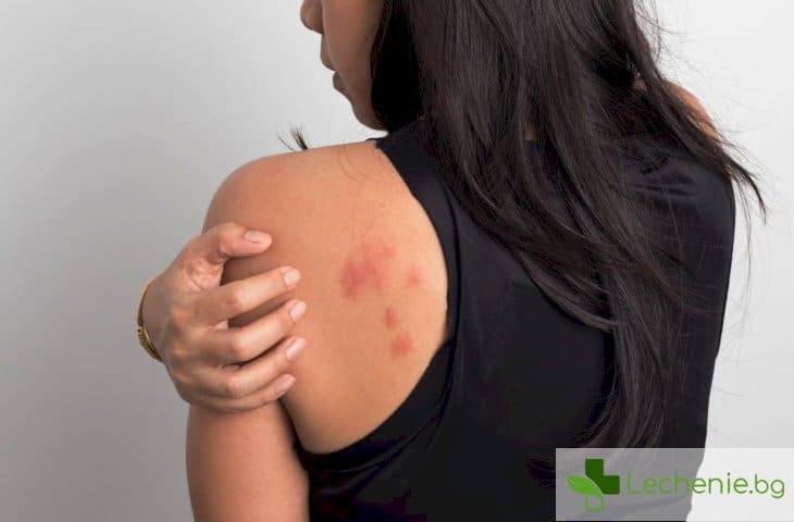 Алергия причинена от дрехи - възможно ли е